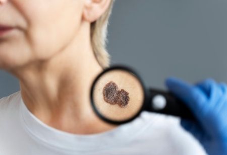  skin cancer therapy